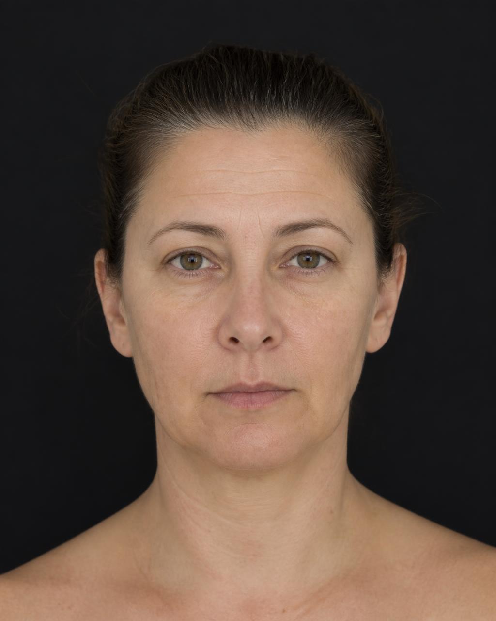 Example patient before photo prior to a Botox and filler treatment